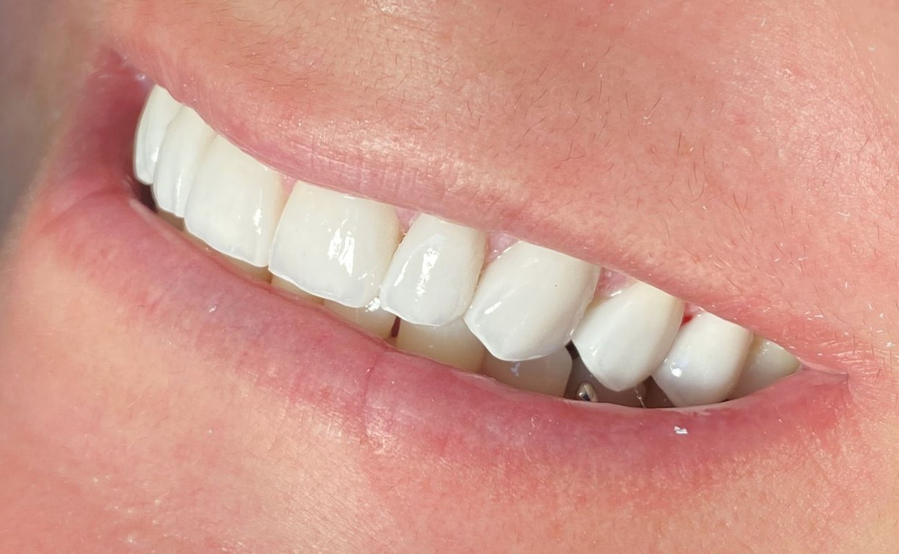 Sorriso renovado de paciente da Seven Odontologia